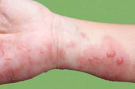 Managing Herpes Made Easy: Your Guide to&nbsp;Valtrex