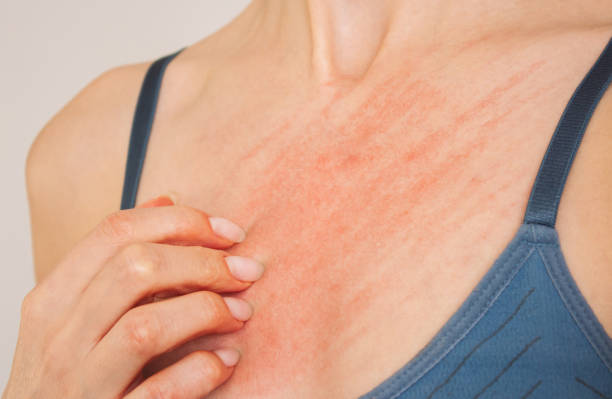 Scabies Symptoms and Solutions: Everything You Should&nbsp;Know